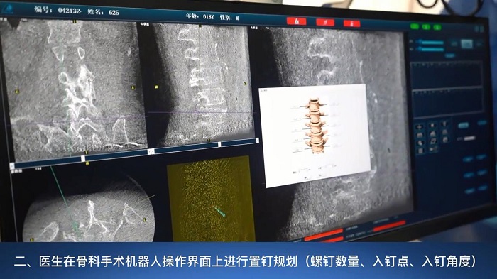 骨科手术机器人和医生分工2